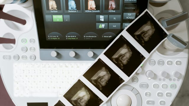 Ultrasound machine displaying 3D scans, with printed sonogram images adjoining.