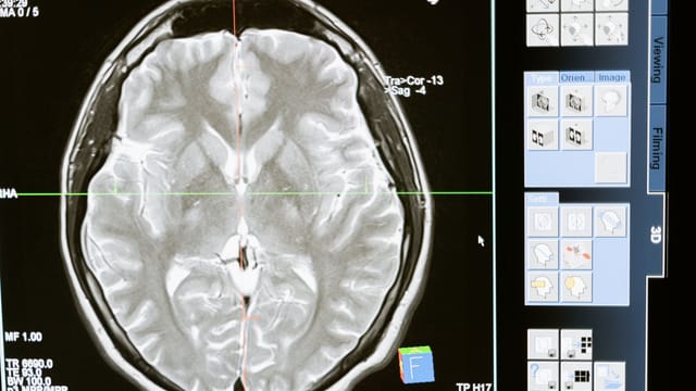 Intricate MRI brain scan displayed on a computer screen for medical analysis and diagnosis.